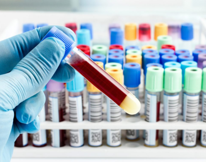 Przygotowanie do badań krwi – najważniejsze zasady